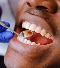 Dental Implants