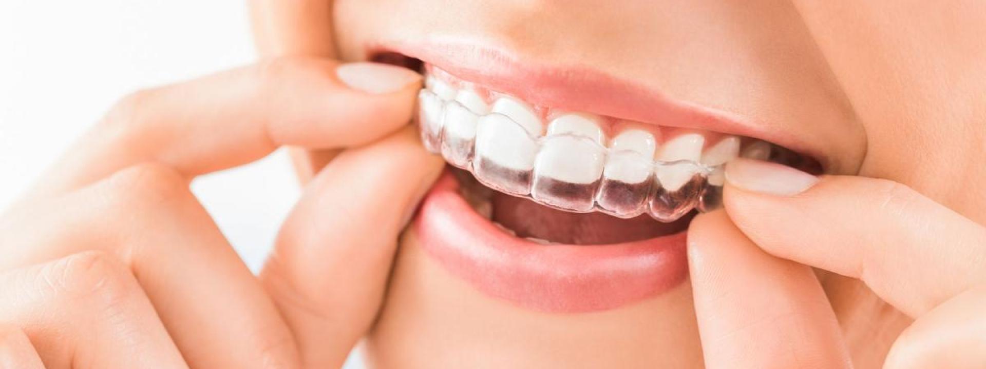 Dental clear aligners